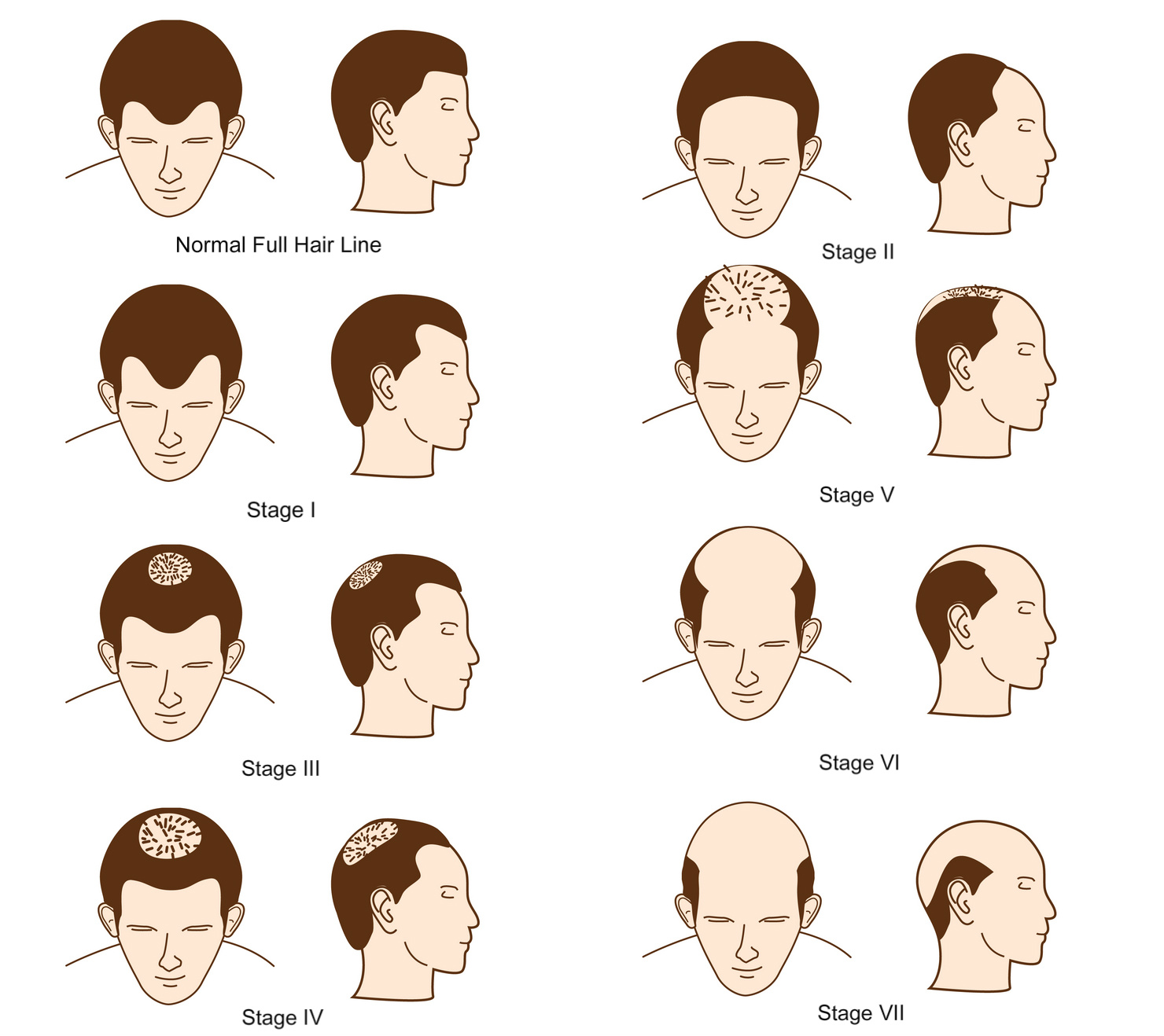 male-pattern-baldness-Hamilton-Scale – Hairfor2